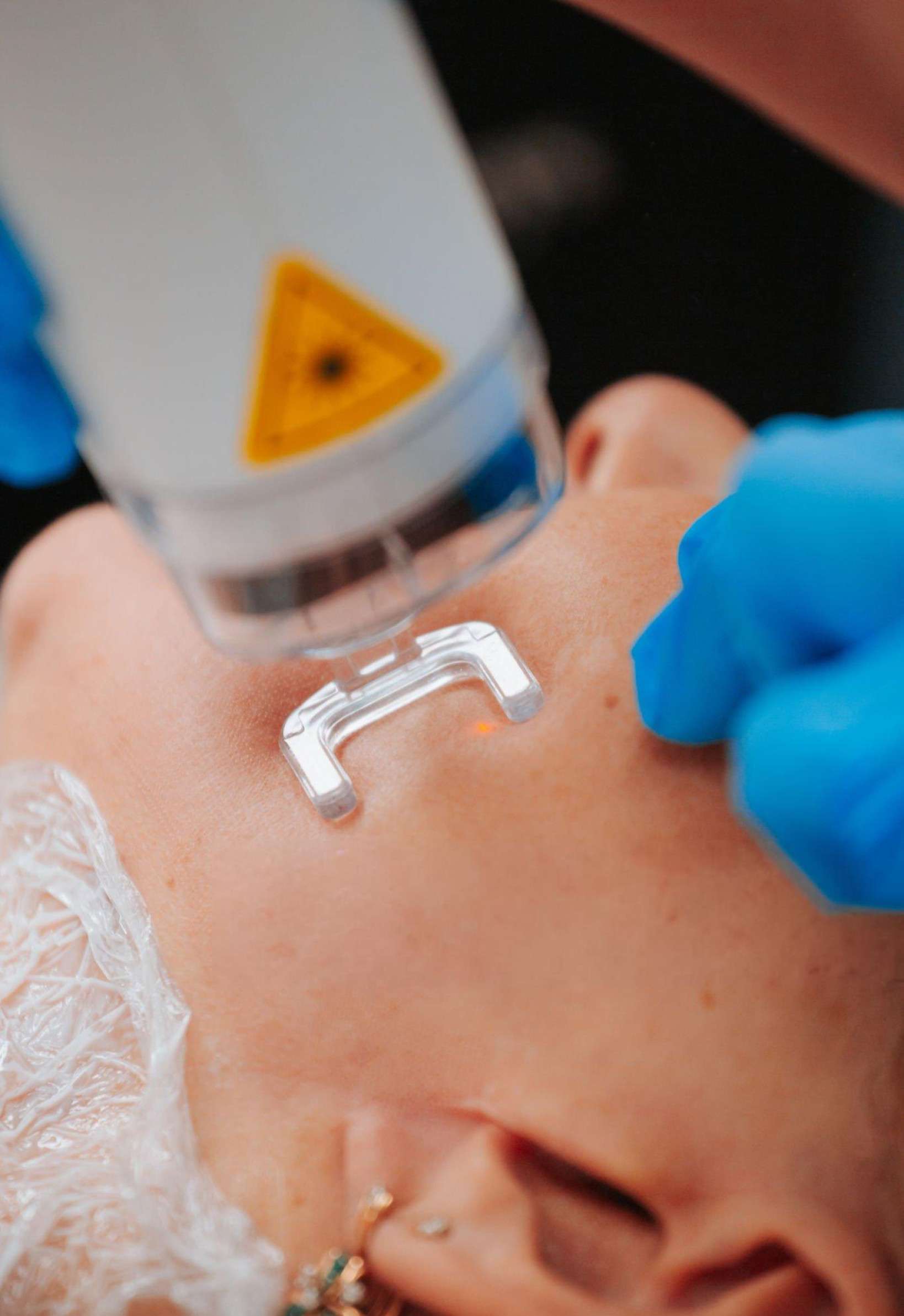 CO2 laser resurfacing treatment